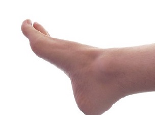 Deforme Ayak Tedavisi